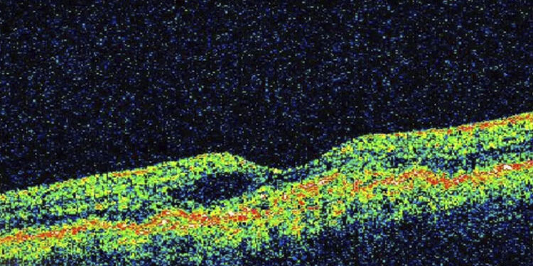 Academia de Ciencias proyectará video sobre enfermedades maculares